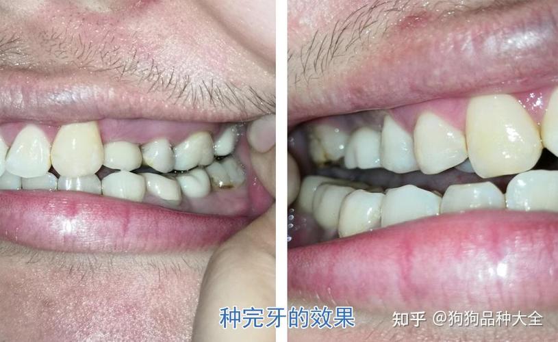 南京赤峰种植牙哪里好 公立三甲靠谱推荐