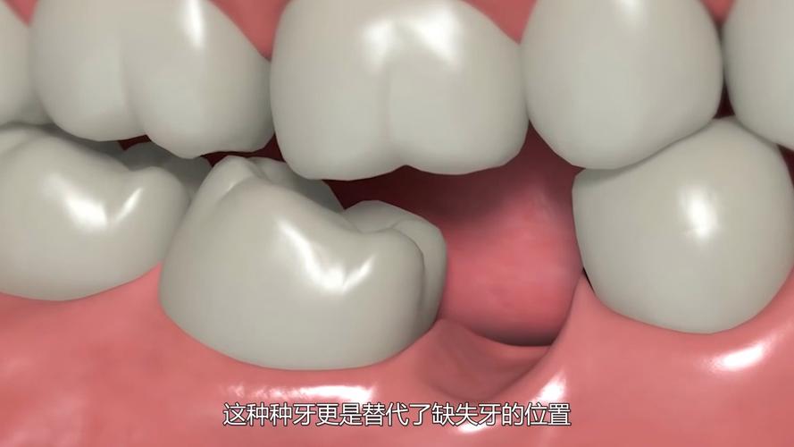 南京种牙到底疼不疼？一篇说清楚植牙真相