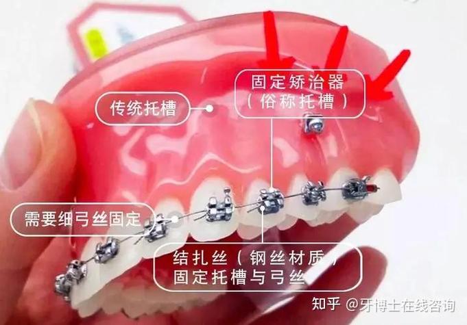 南京深圳龙岗做隐适美矫正到底要花多少钱？