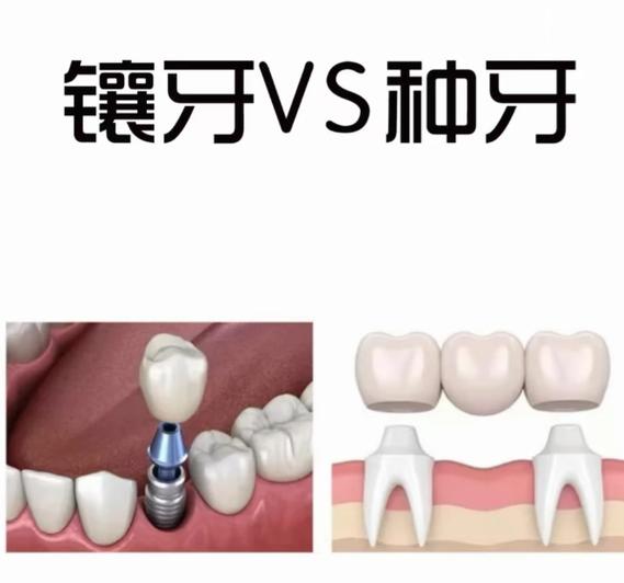 南京海口种植牙2026价格:单颗4000-6000元真实吗