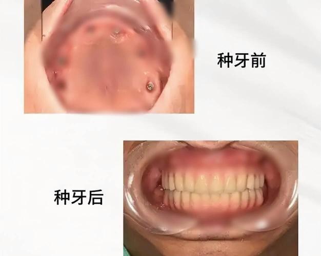 南京70多岁还能种牙吗？种牙风险大不大？