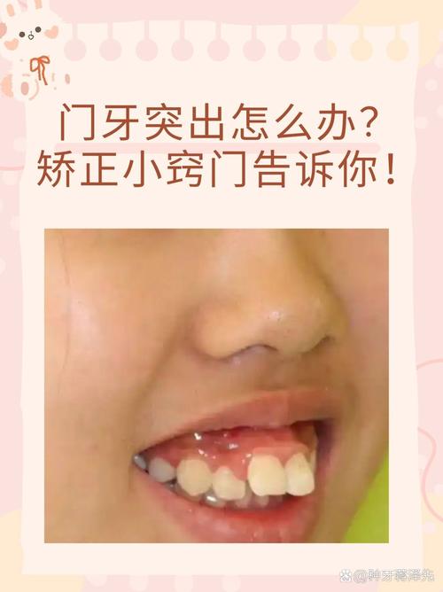 南京10岁孩子门牙突出,医生揭秘:抓住黄金期,这个最快