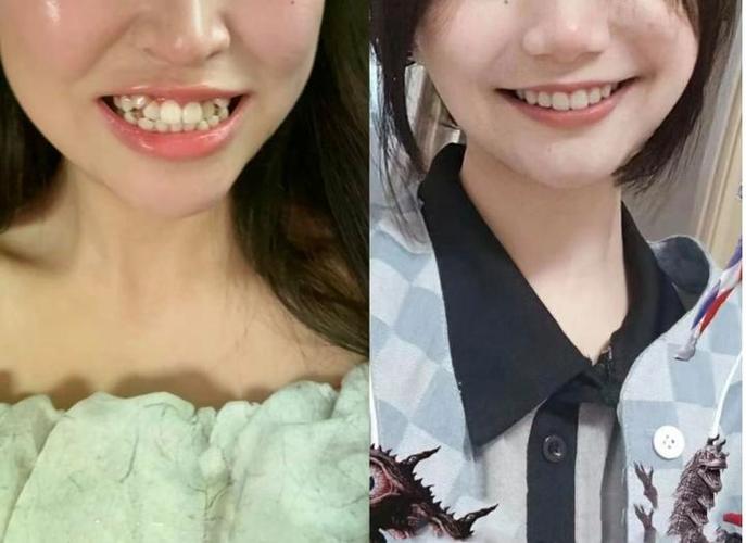 南京36岁还能矫正牙齿吗 成人正畸的真相与风险