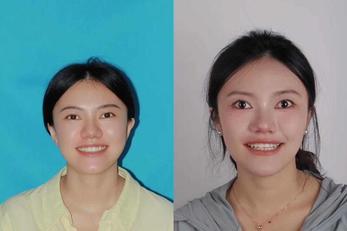 南京20岁矫正牙齿晚不晚？过来人告诉你真实答案