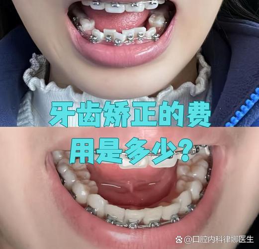 南京30岁矫正牙齿一般花多少钱