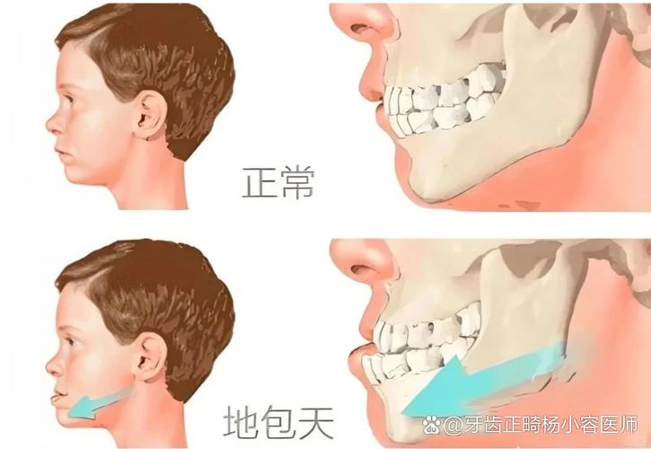 南京12岁小孩能做牙齿矫正吗？别等换完牙才后悔