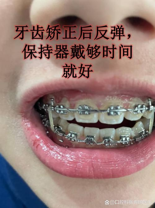 南京6d牙齿矫正器有用吗?牙医揭秘:美容陷阱,小心伤牙
