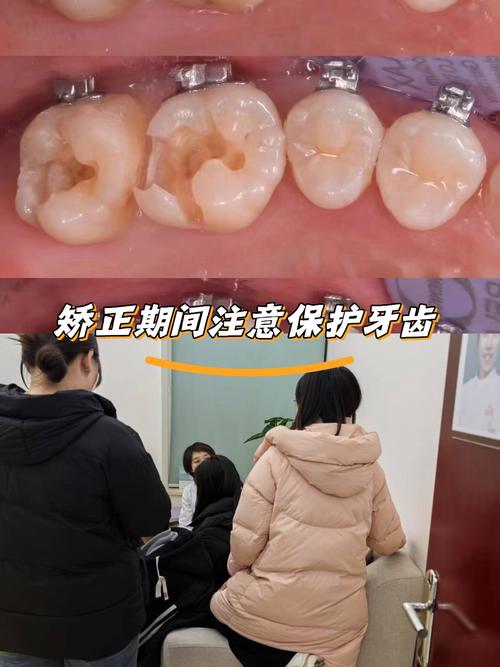 牙齿矫正器能用多久_6d牙齿矫正器有用吗_牙齿矫正器分大小吗