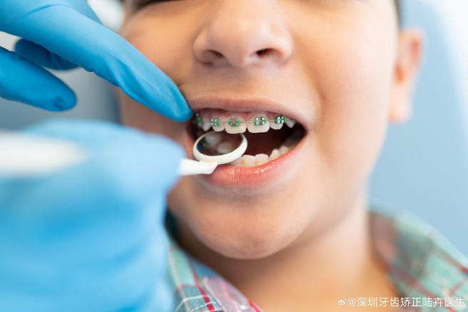 南京8岁孩子门牙龅牙矫正方法 儿童早期干预怎么做