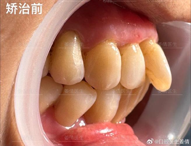 南京60岁还能做牙齿矫正吗