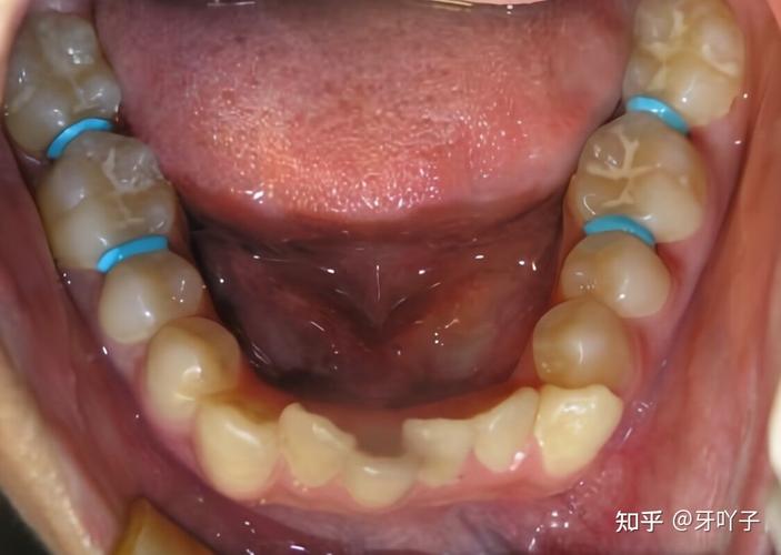 南京玉林牙齿矫正效果怎么样?看完这篇就心里有数了