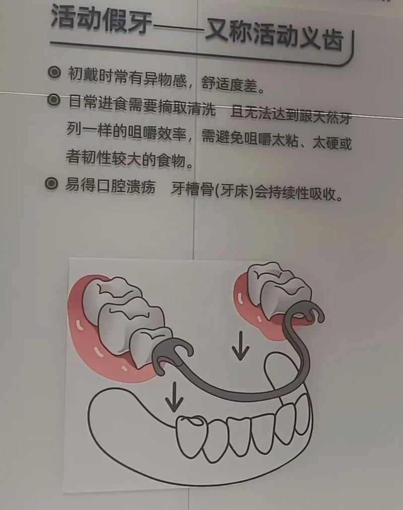 南京活动假牙固定假牙种植牙哪个好 牙医一次说清别再被忽悠