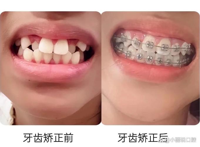 南京15岁牙齿不齐怎么办 专家说三种矫正方式哪种最适合你