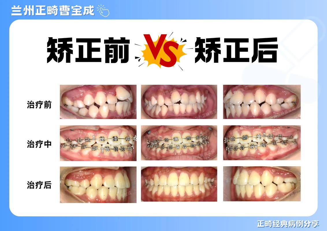矫正整齐的牙齿_15岁牙齿不齐如何纠正_整齐牙齿