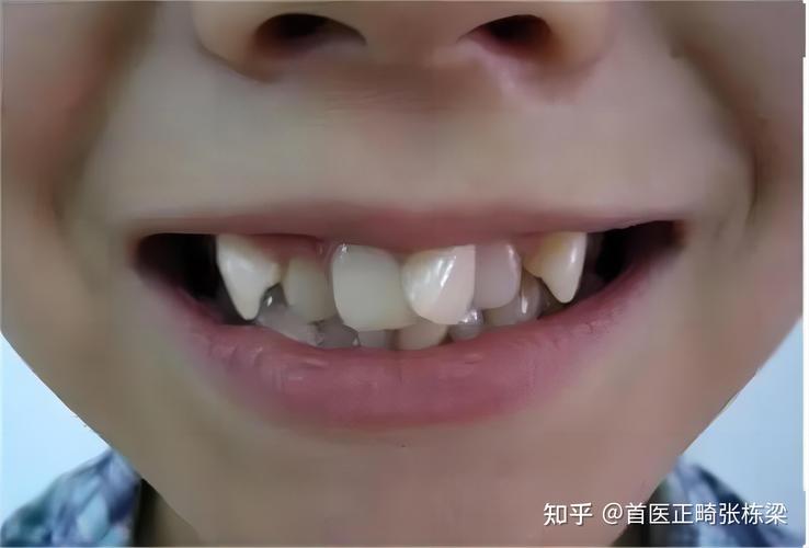 南京深圳儿童地包天最佳矫正年龄是多少?别等换牙误了大事
