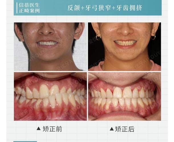 南京深圳中学生牙齿矫正优惠活动真的靠谱吗？
