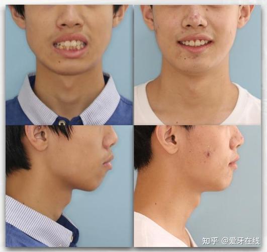 南京呼和浩特牙齿矫正靠不靠谱？效果真实揭秘