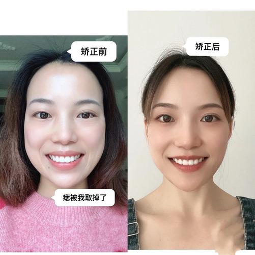 南京成年人牙齿矫正还来得及吗