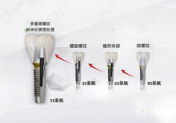南京唐山韩系奥齿泰种植牙2026最新费用一览
