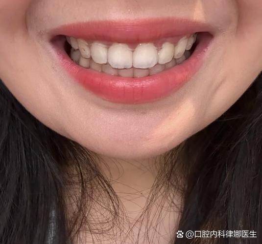 南京23岁牙不齐还能整吗?正畸黄金期过了没