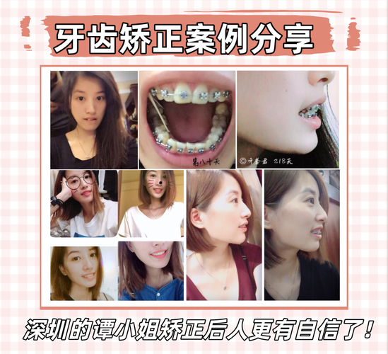 南京深圳骨性龅牙正畸哪家医院靠谱？这3家别踩坑！