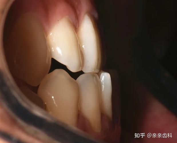 南京宿迁牙齿矫正大概要花多少钱?本地人帮你算笔账