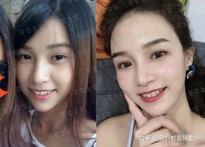 南京43岁矫正深覆合牙齿要多少钱？从检查到摘牙套费用全掰扯清楚