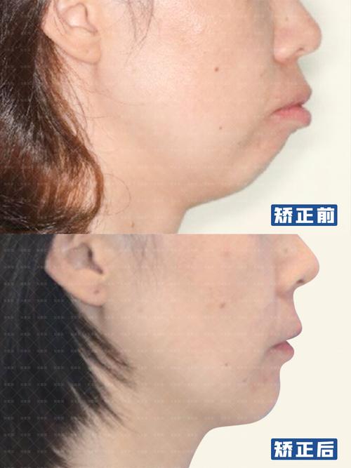 南京矫正牙齿能改善下巴后缩吗？3个关键问题正畸医生一次说清