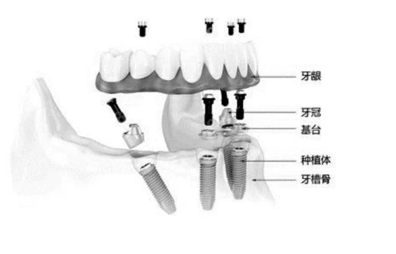 南京半口种牙费用不固定 一颗大概多少钱