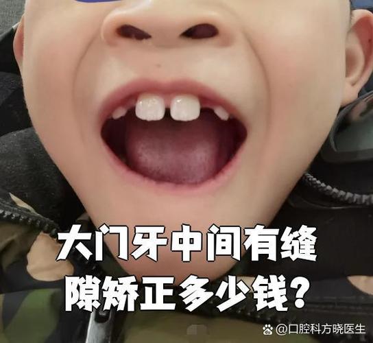 南京保定矫正牙齿费用一览:一般多少钱?价格明细来了