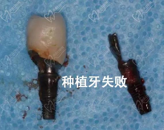 南京深圳福田单颗种植牙哪家医院靠谱？看这里就对了！