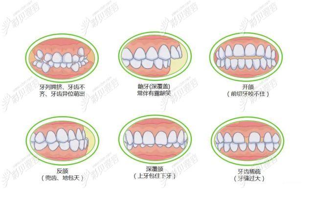 南京南阳牙齿矫正多少钱?2026最新价格大公开