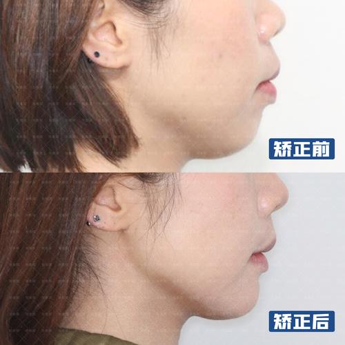 南京30多岁做牙齿矫正晚吗?成人正畸的真相赶紧看