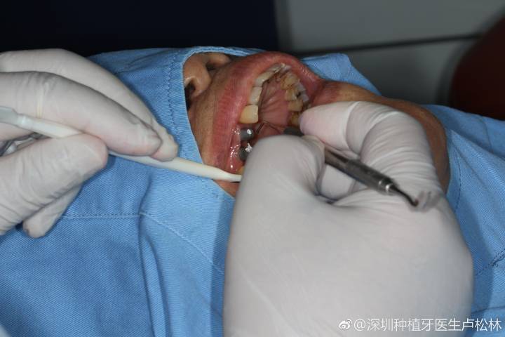 南京80岁还能种牙吗?医生说只要满足这个条件就能做