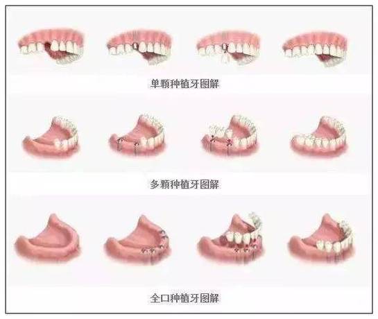 南京半口种植牙全过程要多久?疼不疼?一步步讲清楚