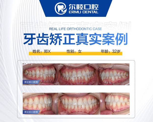南京成人矫正牙齿咬合疼不疼？效果和费用全解析