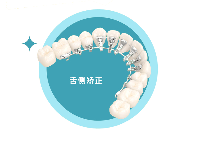 南京成年人牙齿舌侧正畸到底值不值？看完这几点就懂了