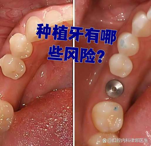 南京全口种植牙的风险和后遗症有哪些