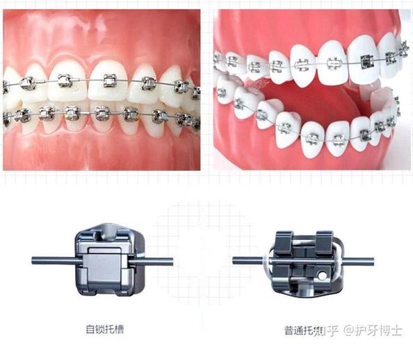 南京暴门牙矫正费用一览