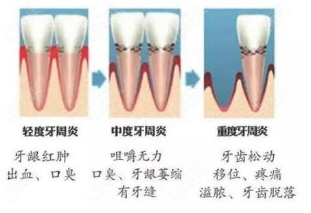 南京深圳牙周炎治疗到底要花多少钱?2026最新费用解析
