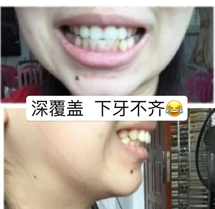 南京39岁牙齿矫正还有用吗 真实效果看这里