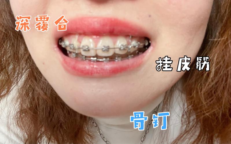 南京深圳深覆合正畸去哪家好?牙科推荐避坑指南
